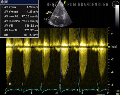 EKG-Messung - Immanuel Herzzentrum Brandenburg in Bernau - Aortenstenose EKG-Messung - Immanuel Herzzentrum Brandenburg in Bernau - Aortenstenose