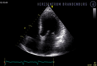 EKG - Immanuel Herzzentrum Brandenburg in Bernau - Myokarditis