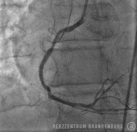 Endergebnis mit erfolgreich behandelter Engstelle Endergebnis mit erfolgreich behandelter Engstelle