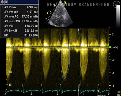 EKG-Messung - Immanuel Herzzentrum Brandenburg in Bernau - Aortenstenose