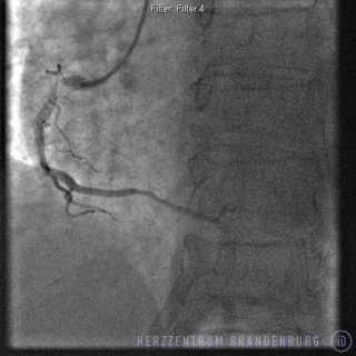 Initial diagnosis: A right coronary artery with stenosis in its mid portion