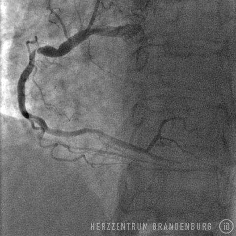 Prior to the procedure: right coronary artery with stenosis