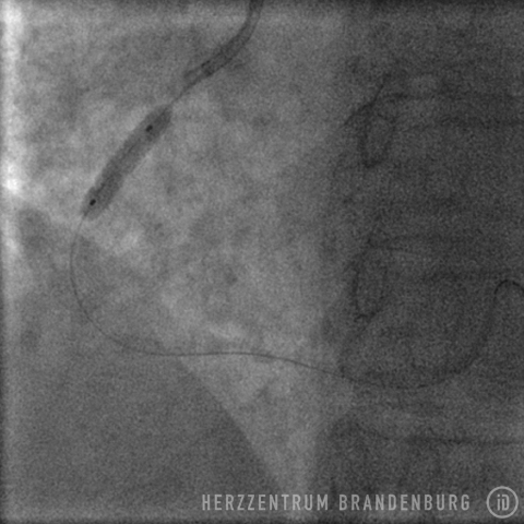 The stent is expanded using the balloon