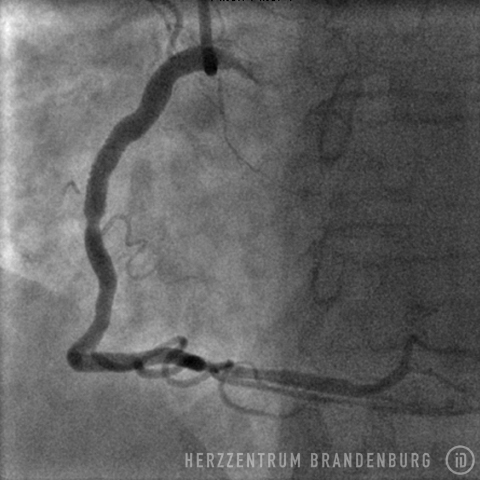 After the procedure: right coronary artery with stent