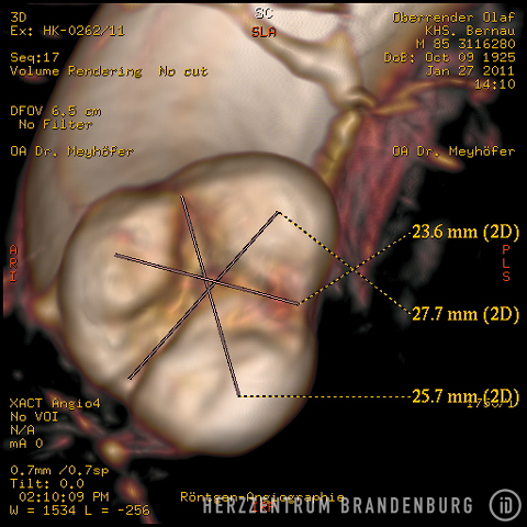 3-D image of the aorta, with measurements