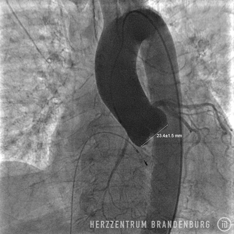 Visualization of the aorta, including measurements, as part of preparations prior to the procedure