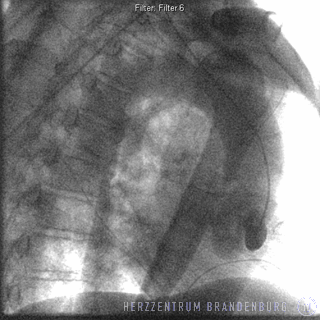 Rotational angiography, allowing precise visualization of the aorta and aortic valve diameter prior to transcatheter aortic valve replacement.