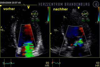 Comparison of mitral regurgitation before and after the MitraClip procedure