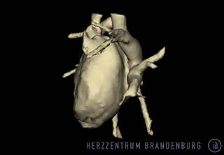 Genaue Darstellung der Anatomie des linken Vorhofes durch Einbindung des CT-3D-Datensatzes in das elektroanatomische Mappingsystem Navix - Immanuel Herzzentrum Brandenburg in Bernau bei Berlin