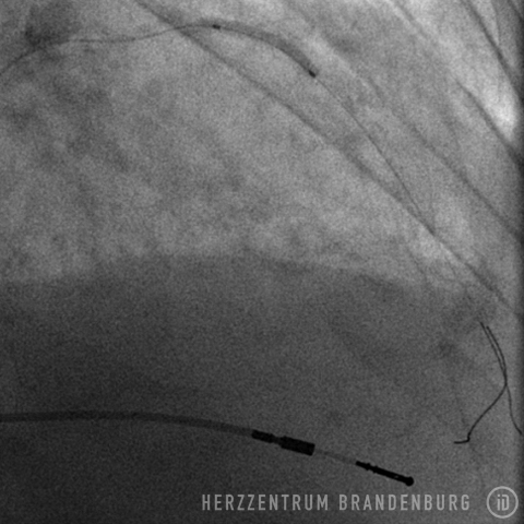 Durchführung einer Ballondilatation um die Implantation von Stents vorzubereiten