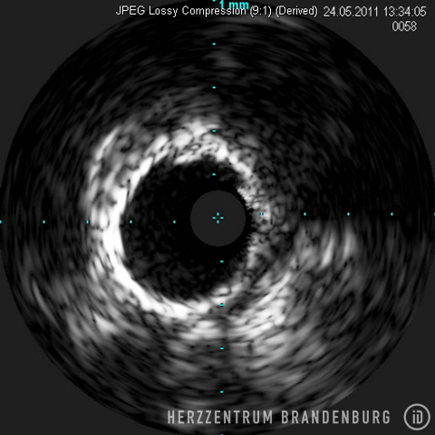 Ultrasound image obtained using IVUS 