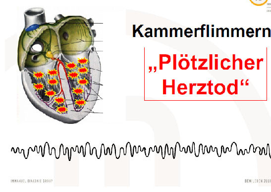 ICD Kammerflimmern - Immanuel Herzzentrum Brandenburg in Bernau bei Berlin