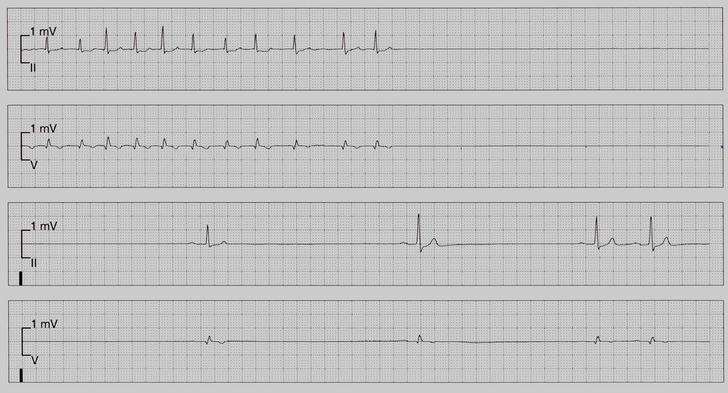 Excerpt from a telemetry recording showing long delays in impulse generation that require pacing support. The patient was admitted for emergency treatment following repeated episodes of fainting (syncope). Telemetric monitoring allowed the patient to be diagnosed as requiring a pacemaker.