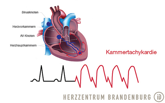 Abbildung Kammertachykardie - Immanuel Herzzentrum Brandenburg in Bernau bei Berlin