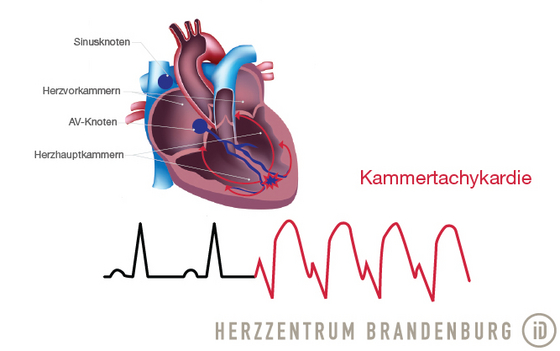 grafische Darstellung ventrikulärer Tachycardie - Immanuel Herzzentrum Brandenburg in Bernau bei Berlin