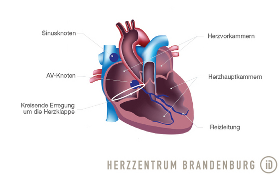 grafische Darstellung Vorhofflattern - Immanuel Herzzentrum Brandenburg in Bernau bei Berlin